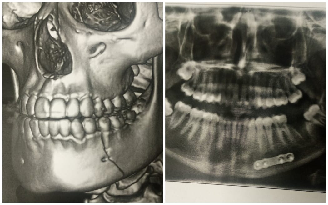 X-rays posted on social media by the teenager's mother.