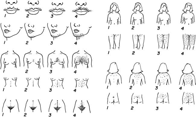 the Ferriman-Gallwey scale 