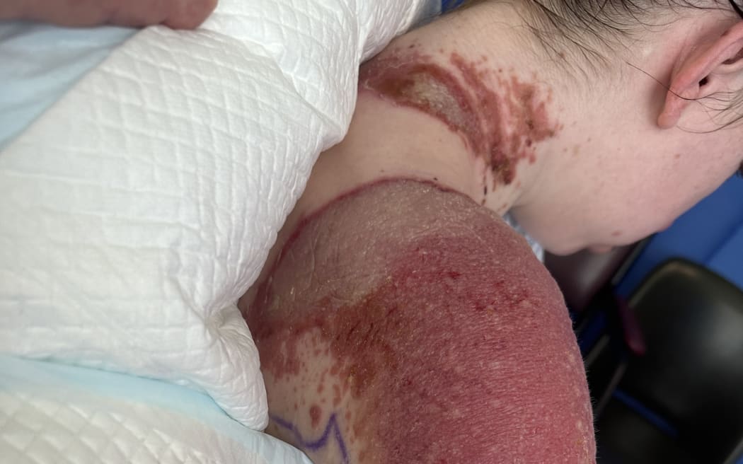 Charlotte's skin developed massive blisters like she had been cooked. She needed a feeding tube because her mouth and oesophagus were burned.