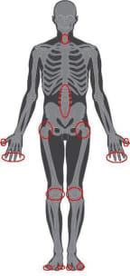 Skeleton showing how osteoarthritis can occur in a number of joints. Mobility can be impaired when it occurs in the hips, knees and ankles.