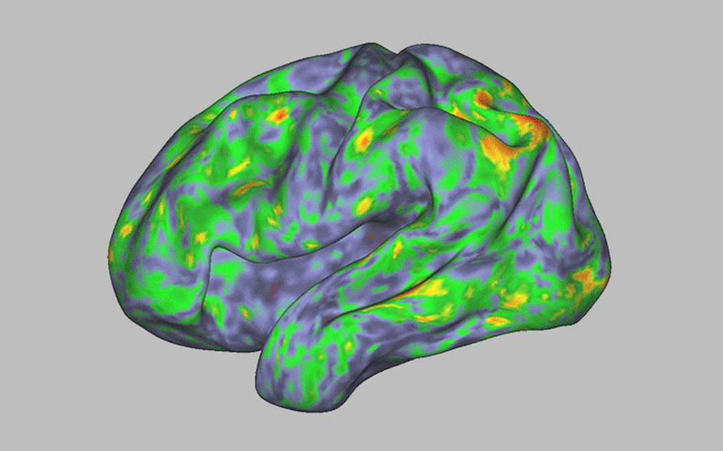 Heat map of brain activity patterns shows profound disturbance during an individual’s experience after taking psilocybin.