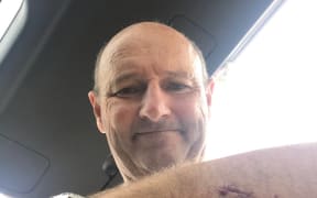 Auckland surfer Nick Minogue was bitten by a Great White shark.