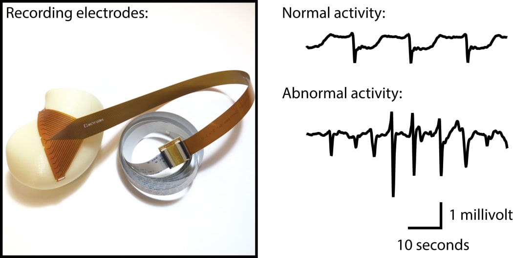 An electrode made using flexible printed circuit technology can be used to map electrical signals in the human stomach.