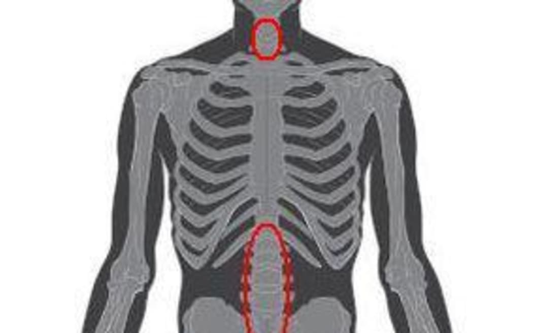 Skeleton showing how osteoarthritis can occur in a number of joints. Mobility can be impaired when it occurs in the hips, knees and ankles.