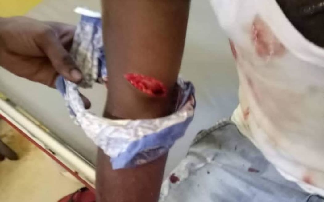 The wounded arm of the refugee.