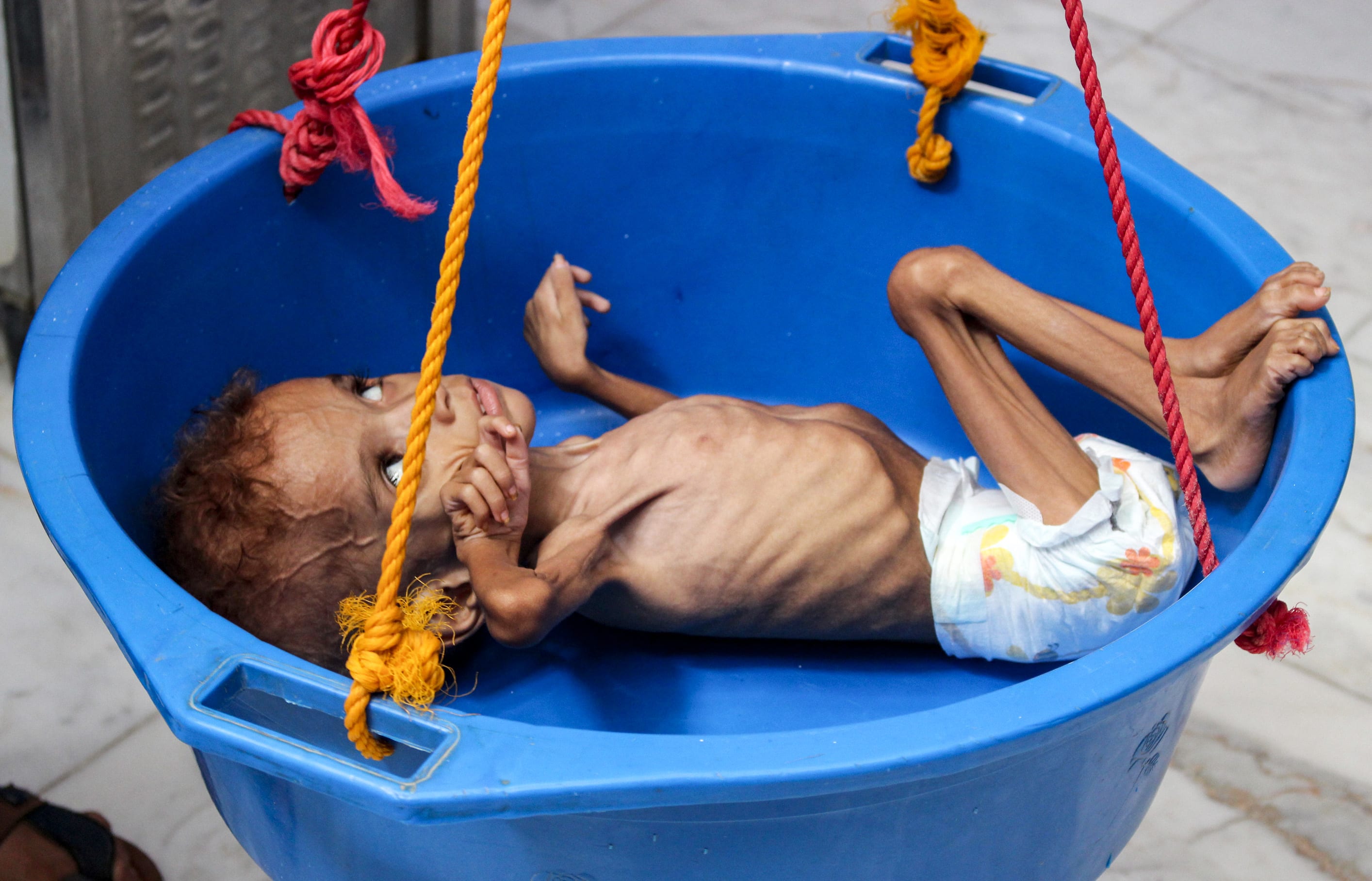 Bassem Mohamed Hassan, a two-year-old Yemeni boy suffering from malnutrition, has his weight measured at a hospital in the northern district of Abs.