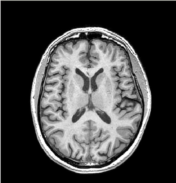 This is a high resolution, anatomical magnetic resonance image of the brain, which gives researchers exquisite detail about the structure of the brain, including the amount of grey matter tissue, white matter tissue, and cerebral spinal fluid.