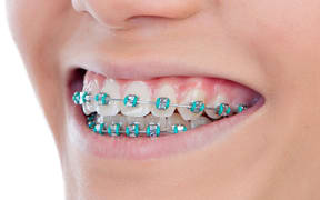 Metal braces for teeth
