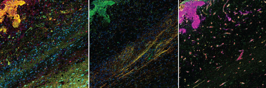 Painting the brain: an example of multiplex fluorescent labelling on human brain tissue illustrating (left to right) different types of brain cells, the highways of brain cell connections, and blood vessels on the same slice of tissue.