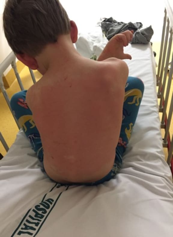 James was in hospital after his severe reaction to a wasp sting.