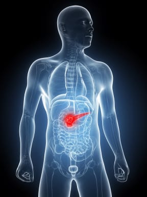 Pancreatic cancer