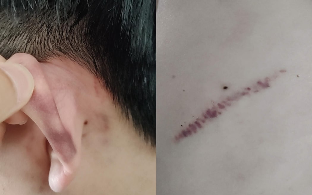 Sun's flatmate suffered bruises.