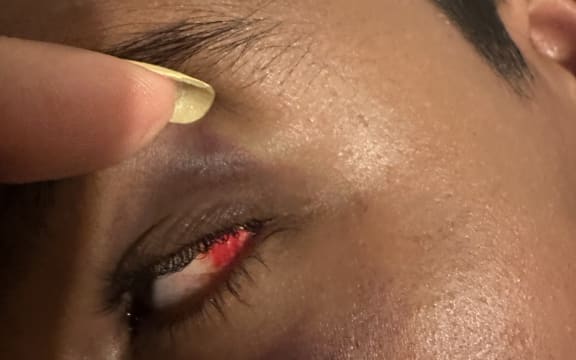 Injury to eye of a Year Nine student attacked at Ashburton College.