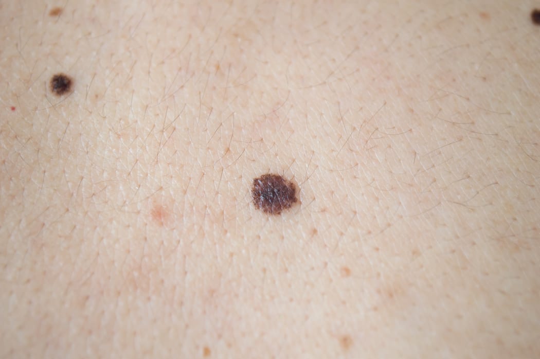 melanoma - skin cancer on a man's back