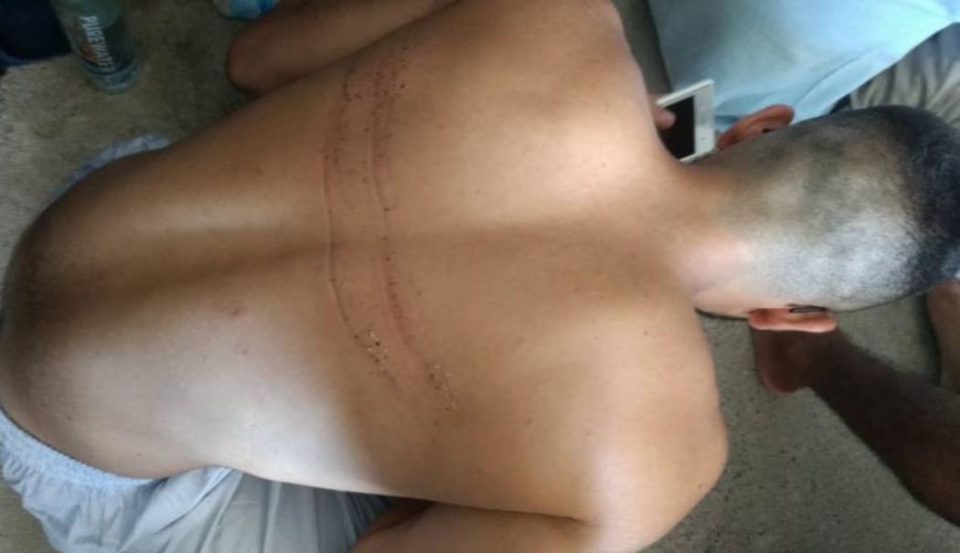 A Manus Island refugee displays wounds allegedly inflicted by police, 23-11-17