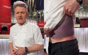 Gordon Ramsay shows off his bruising after a cycling mishap.