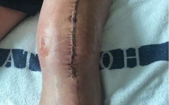 Doctors considered amputating Lee Runga's knee after sepsis attacked tissue around an old rugby injury.