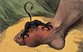 Gout is represented by an attacking demon in a 1799 etching by James Gillray.