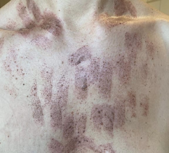 A Wellington woman has been left with burn marks all over her chest from an IPL treatment on 8 February 2024 (for use with this story ONLY).