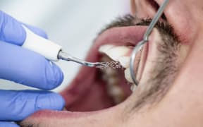 Removing dental tartar. (Photo by MICROGEN IMAGES/SCIENCE PHOTO LI / SMD / Science Photo Library via AFP)