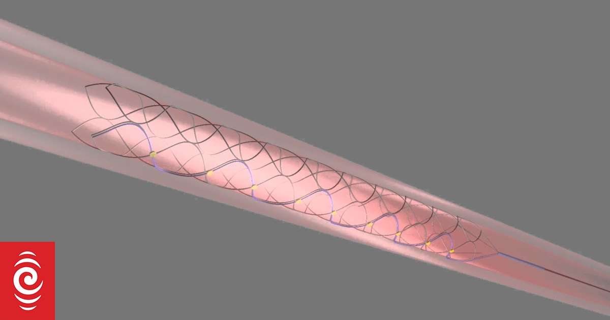 Bionic spine | RNZ