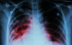 Pulmonary Tuberculosis ( TB )  :  Chest x-ray show alveolar infiltration at both lung due to mycobacterium tuberculosis infection