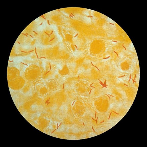 Photomicrograph of a sputum sample containing Mycobacterium tuberculosis.
