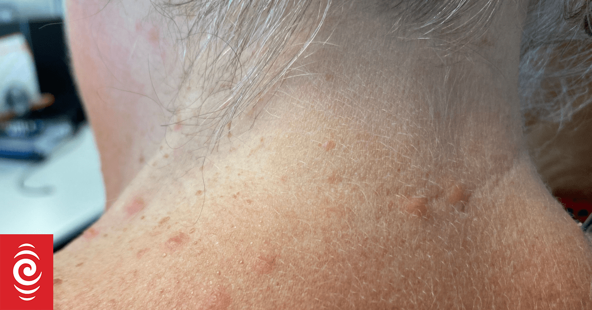 Microscopic jellyfish bring unwelcome sting for Bream Bay swimmers