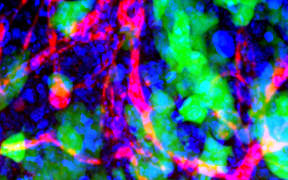 Nanoparticles in Brain Metastases
