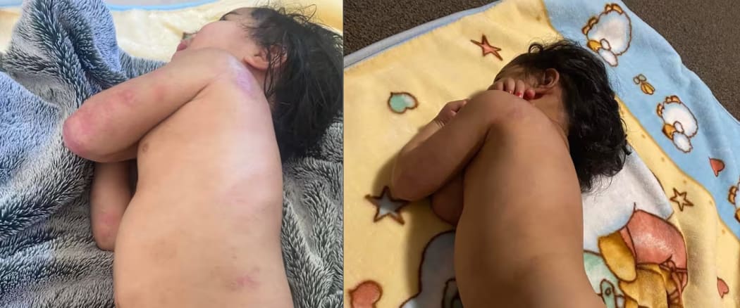 Monica Maoate pictured before and after using the NaturaCoco cream for eczema. It worked, but wasn't safe and is now banned.