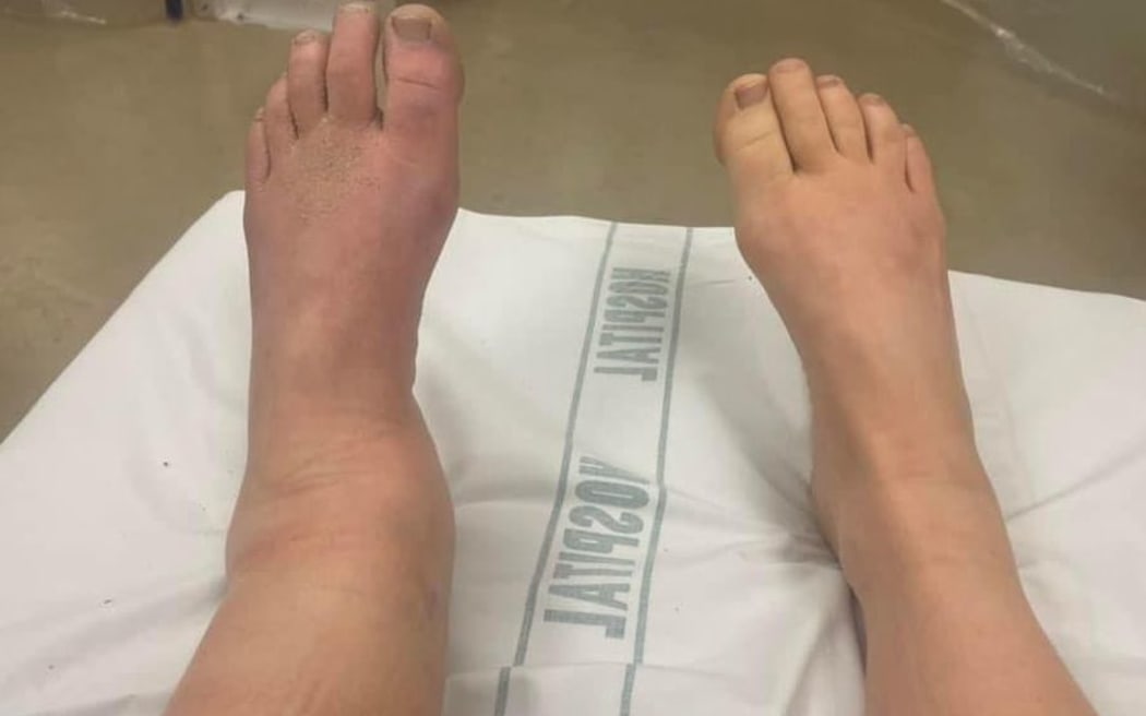 Georgina Lloyd's broken leg