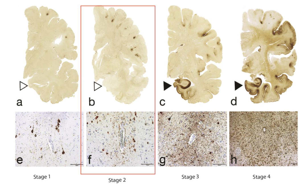 Scanned images of a brain affected by various stages of Chronic Traumatic Encepahlopathy (CTE)