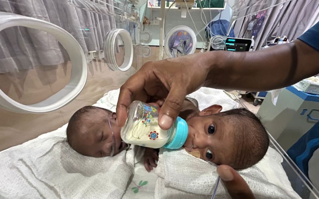 Papua New Guinea conjoined twins