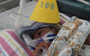 Conjoined twin Sawong from PNG wears a party hat as his family and staff at Sydney Children’s Hospital celebrate him reaching 100 days old.