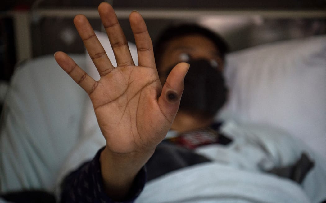 (FILES) This file photo taken on August 16, 2022 shows a patient showing his hand with a sore caused by an infection of the monkeypox virus, in the isolation area for monkeypox patients at the Arzobispo Loayza hospital, in Lima, Peru. Shares of the pharmaceutical laboratories of Bavarian Nordic in Denmark, which manufactures a specific vaccine against the mpox, jumped up on August 15, 2024 following the decision of the World Organization of Health WHO to consider the resurgence of monkeypox cases together with an urgent need for health care in the world. A surging mpox outbreak in Africa, which was declared an emergency by the continent's health agency on August 13, is being driven by a new, more transmissible strain of the virus. The Africa Centres for Disease Control and Prevention (Africa CDC) declared its first-ever Public Health Emergency of Continental Security (PHECS) for the deadly disease. Bavarian Nordic mainly supplies its mpox vaccine - called Jynneos in the US, Imvanex in the European Union -...