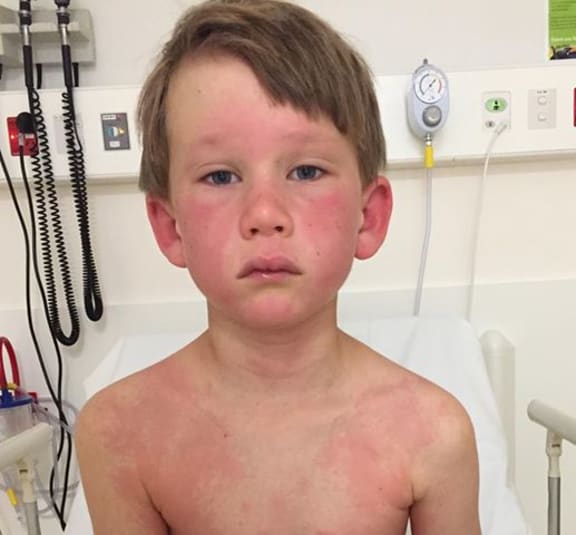 Eight-year-old James suffered an anaphylactic shock from a wasp sting.