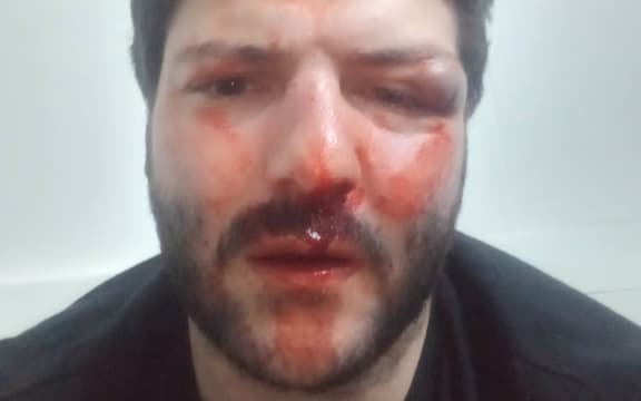 Daniel - RNZ is not using his surname - suffered these injuries in the 10 January incident.