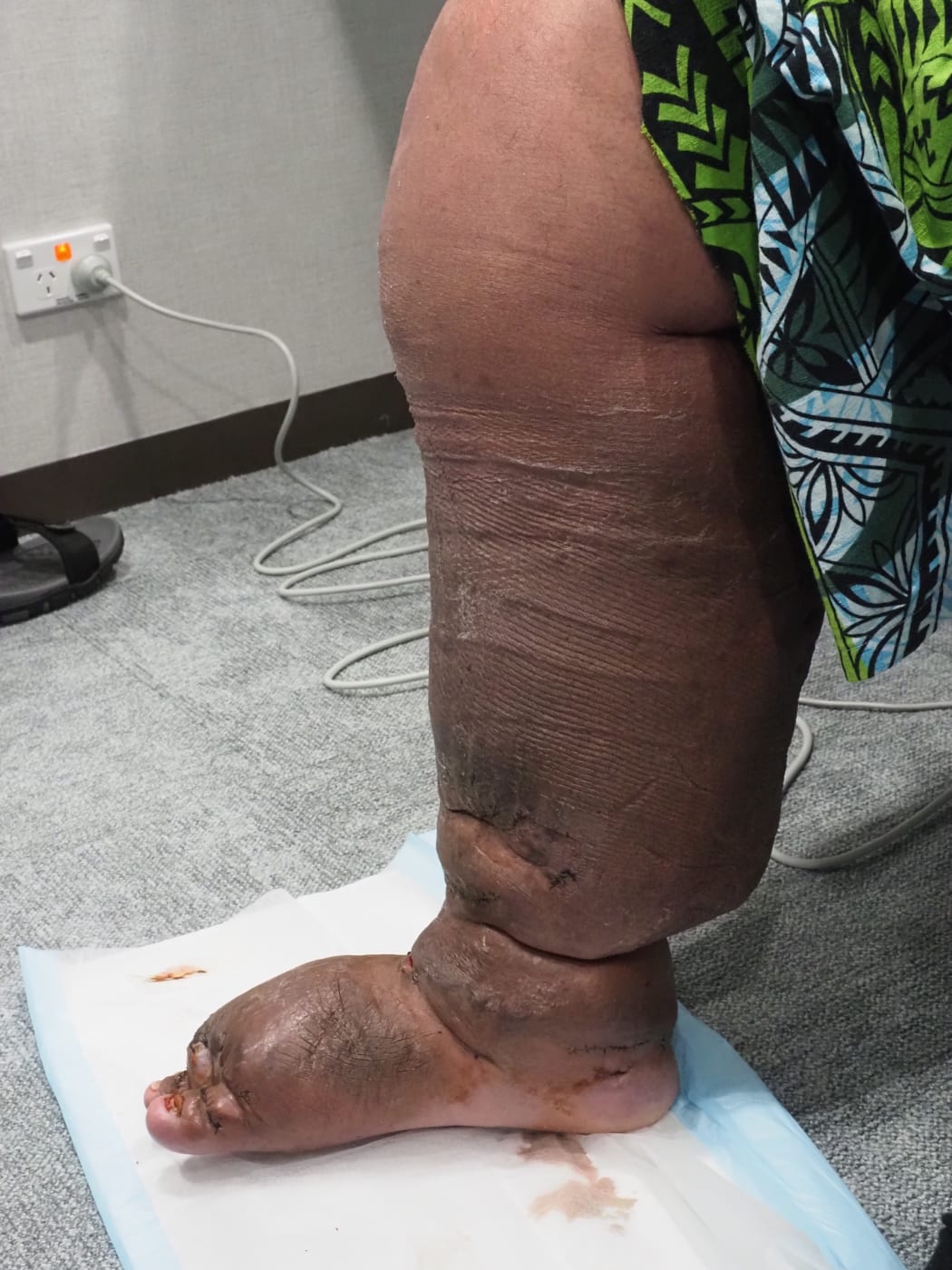 Auckland surgeon Simon Chong has carried out a pro bono surgery for American Samoan man Lautaimi Faumuina, to treat the lymphoedema that enlarged his leg.
