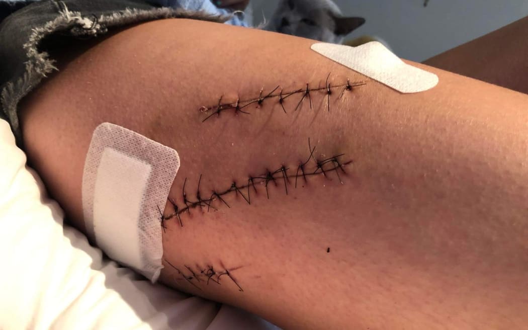 One of the victim's injuries.