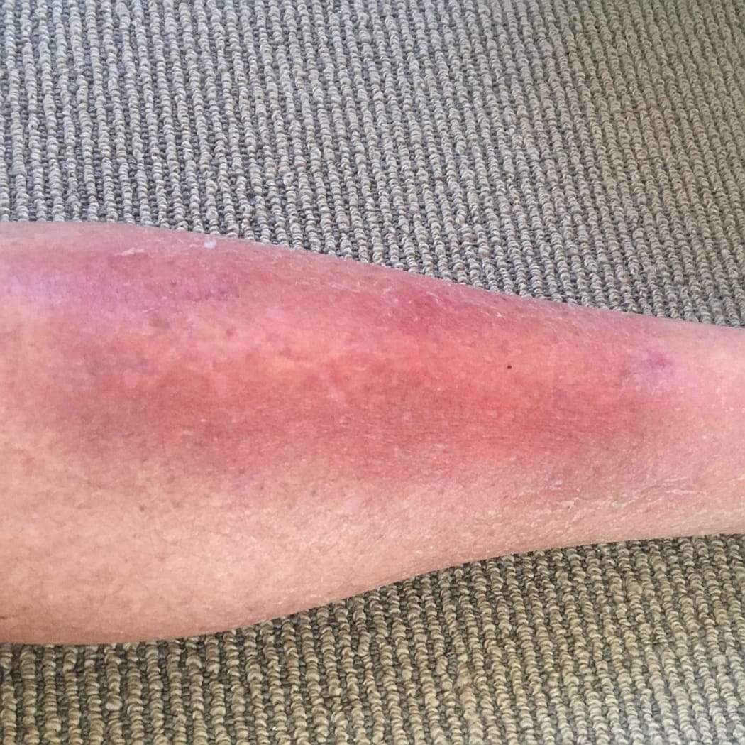 A closeup of Bruce's left leg. His cellulitis infection is nearly healed.