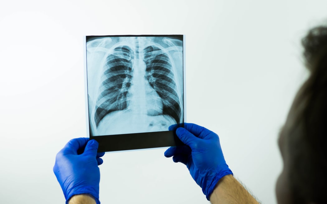 The doctor makes an x-ray analysis of the lungs of a picture on a white background, a medical worker holds an x-ray in his hands and examines the disease, close-up.