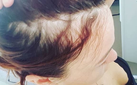 One of the symptoms Nikki said she had was random white patches of hair.