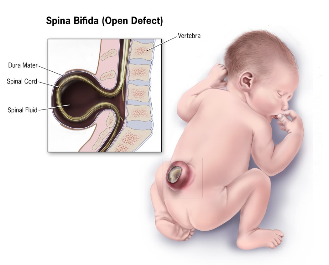 Spina bifida is where a baby's spinal column fails to develop properly, and can lead to a host of health problems that can be costly and dangerous to repair.