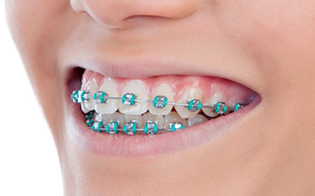 Metal braces for teeth