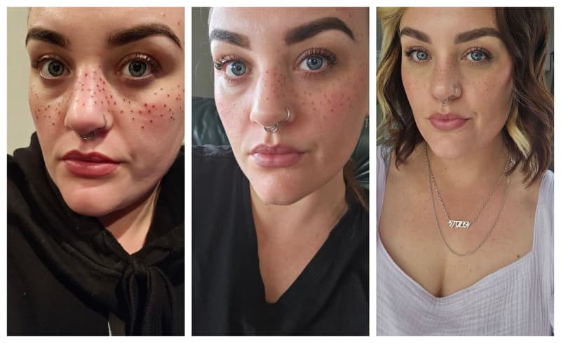 Alex Borrett and her freckle tattoos.