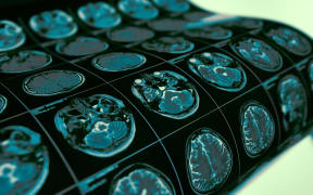 MRI examination film of patient's head as a medical diagnostic background.