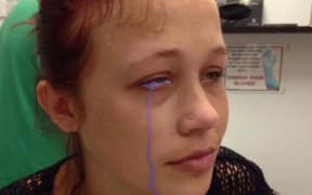 Catt Gallinger posted images on social medida to raise awareness of the dangers of scleral tattooing.