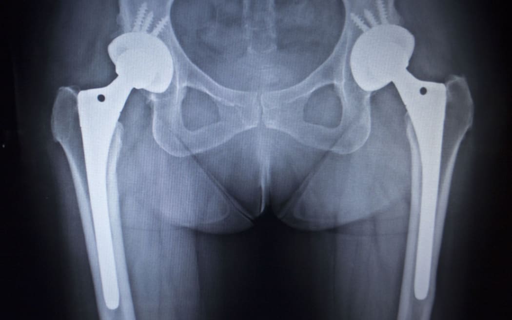 Hip implant, file photo