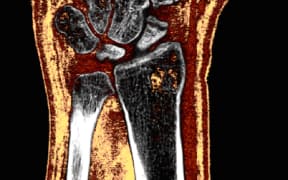 MARS scan of a wrist with a scaphoid fracture