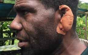 Chief George Natau who was one of the people hurt by stone throwing youths